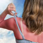 natural sunburn remedies