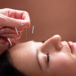 Acupuncture health benefits