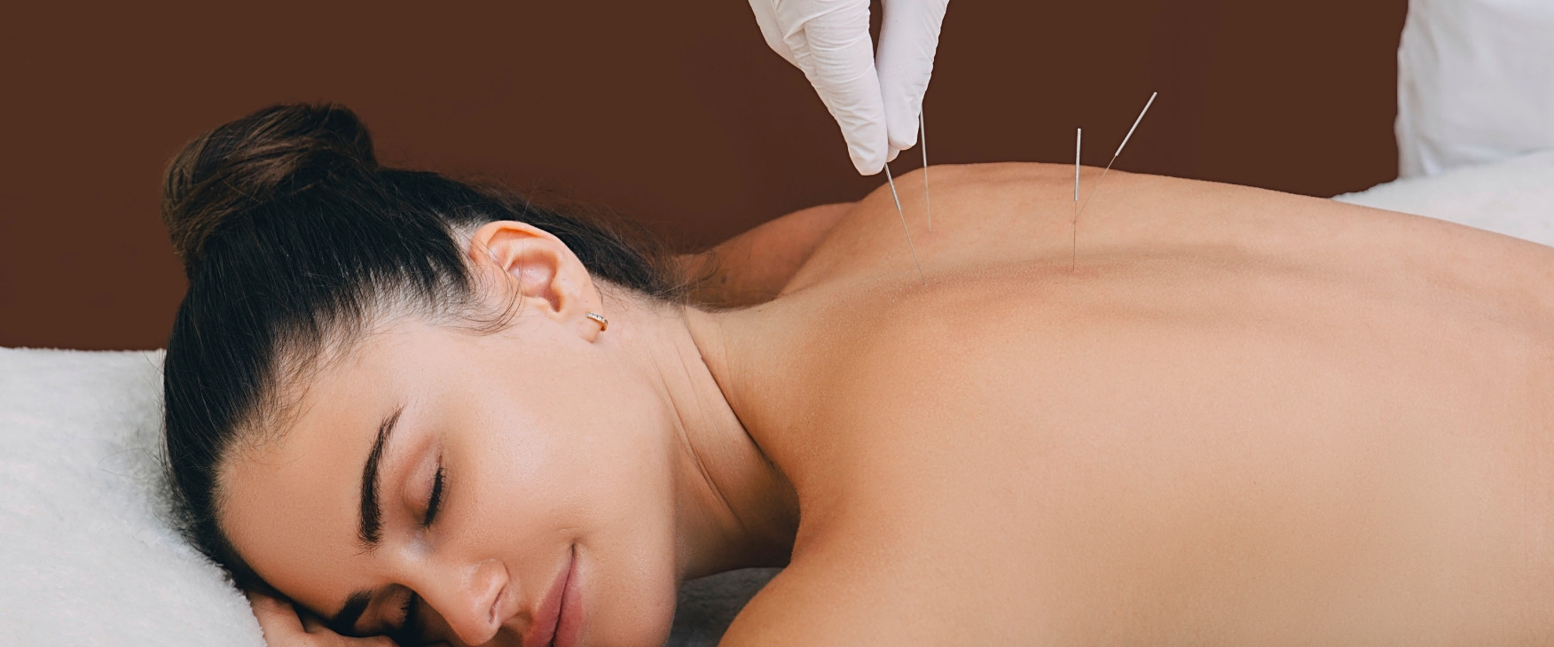 Acupuncture for Anxiety, Stress, and Better Sleep: What You Need to Know